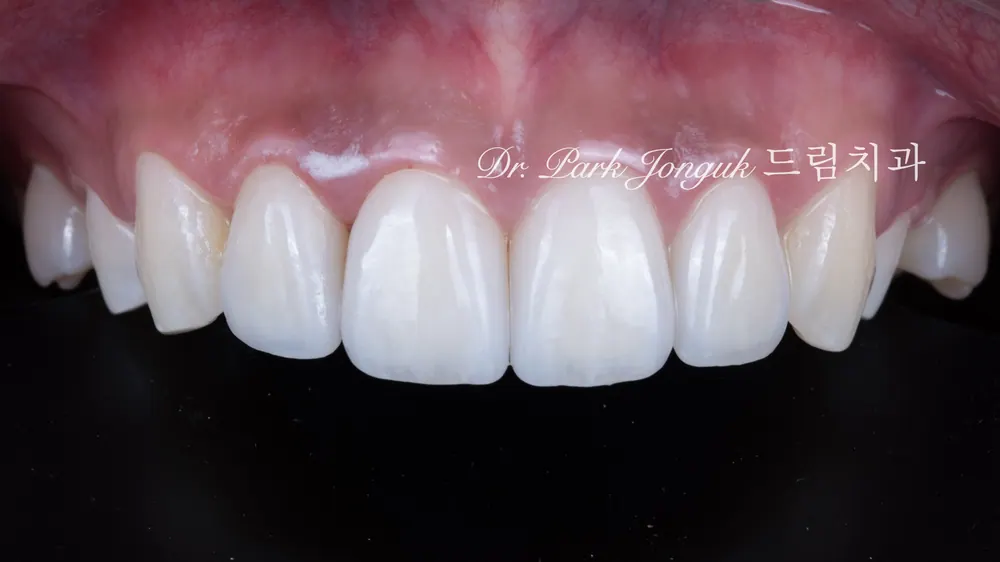 Làm lại veneer sứ răng cửa