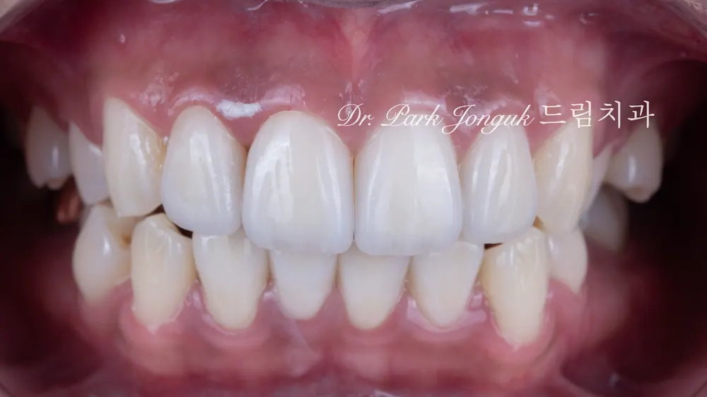Làm lại veneer sứ răng cửa