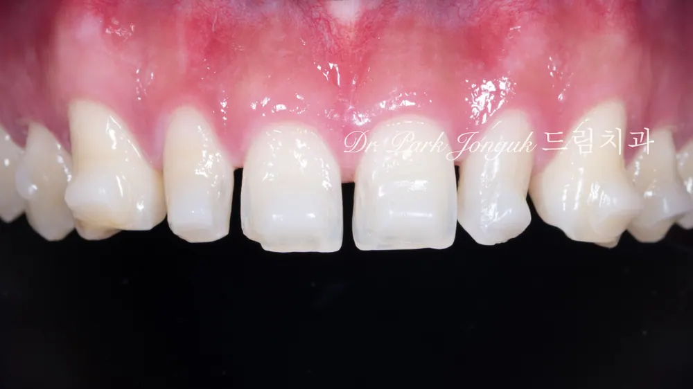 No-prep veneers after Invisalign