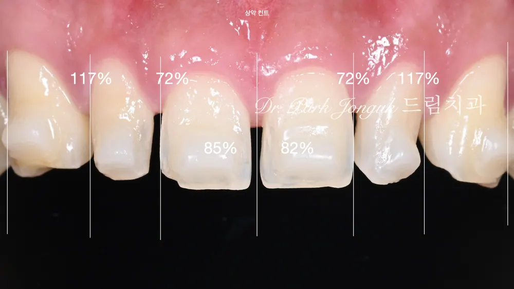 No-prep veneers after Invisalign