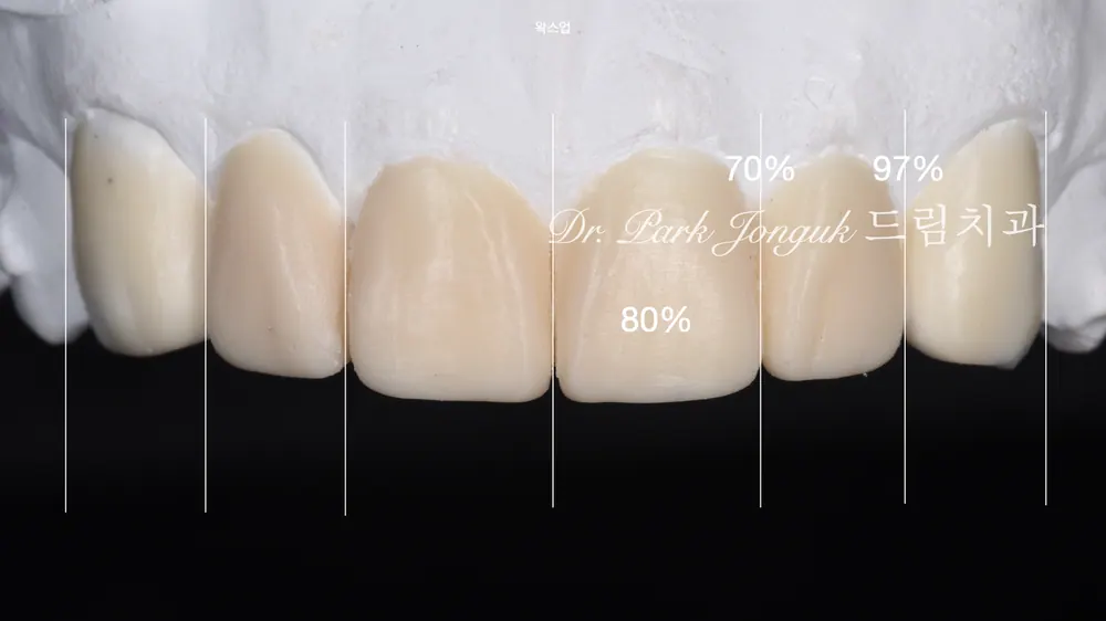 [Veneers After Invisalign] Solving a Peg Lateral After Orthodontics! Designing 'No-Prep Veneers' to Preserve the Tooth (Dream Dental Clinic) — photo 3