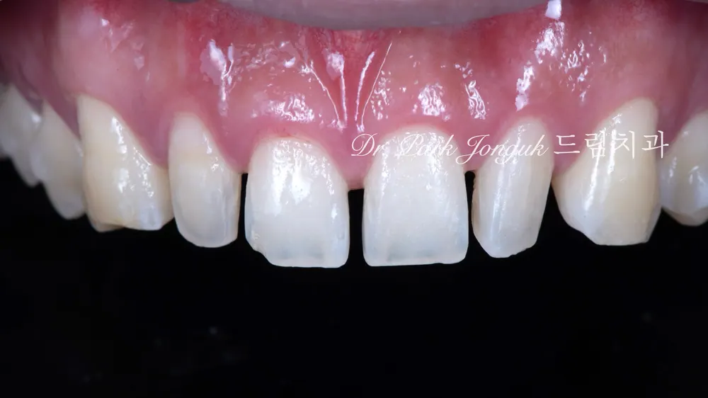 No-prep veneers after Invisalign