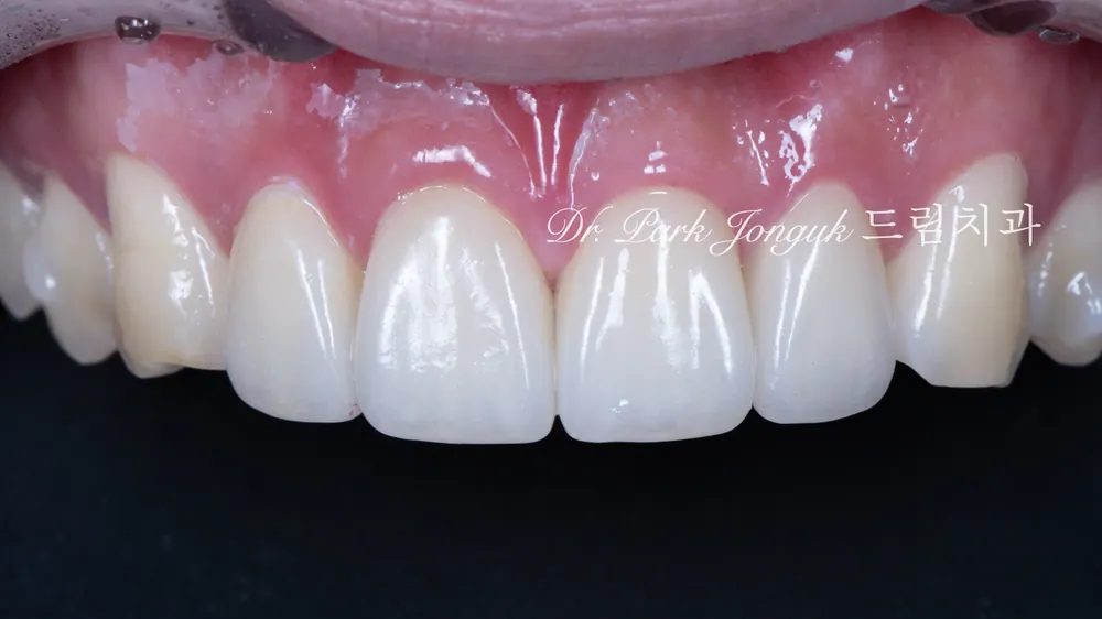 No-prep veneers after Invisalign
