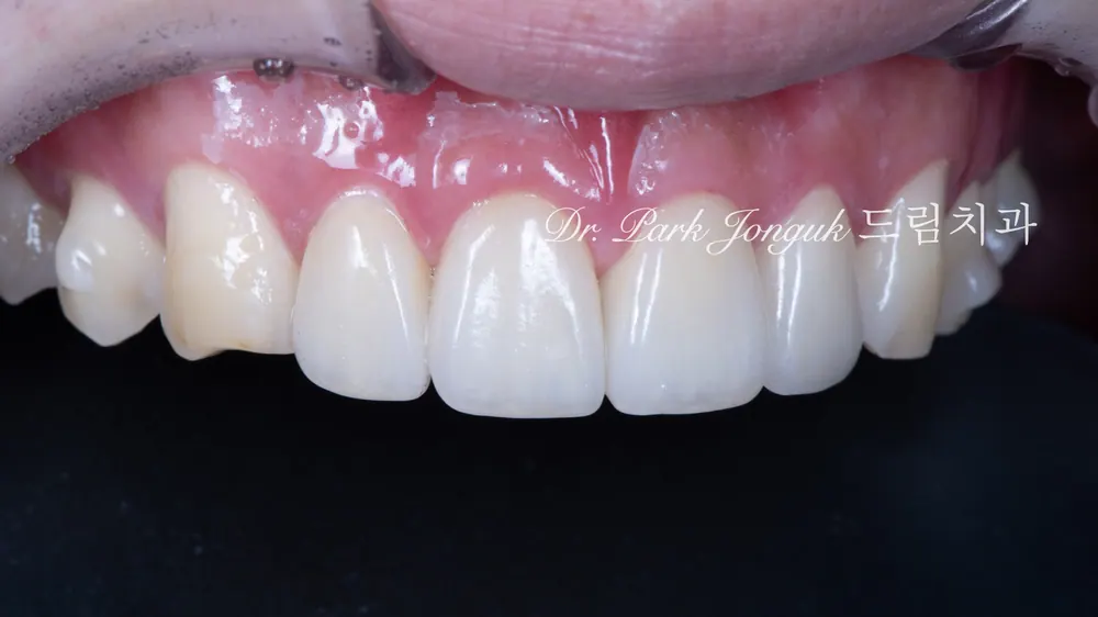No-prep veneers after Invisalign