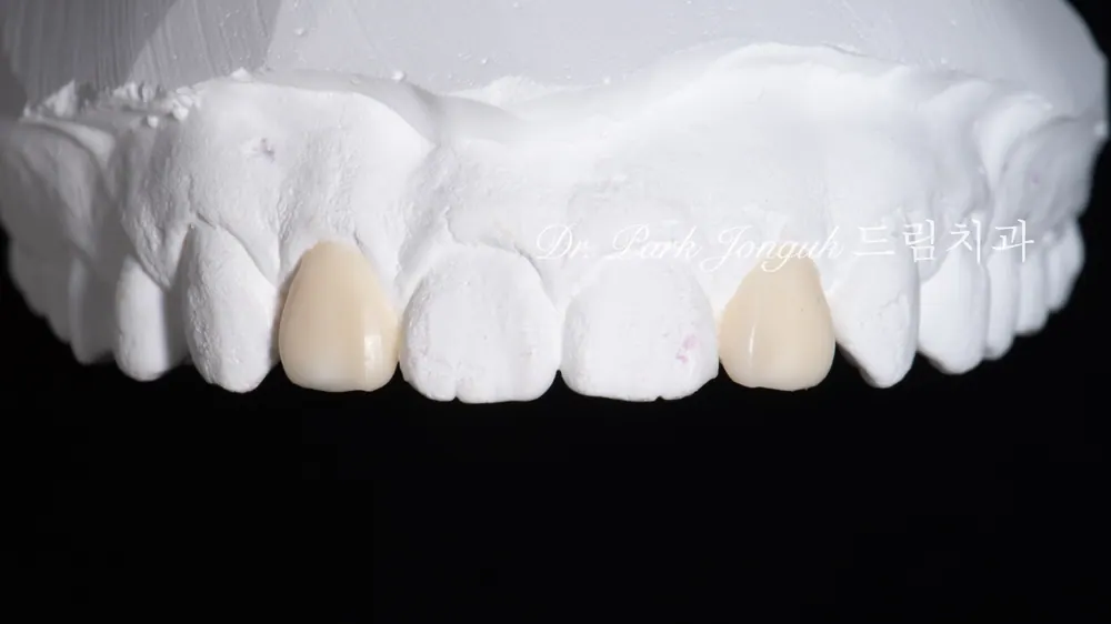 No-prep veneers for peg laterals after braces on both front teeth