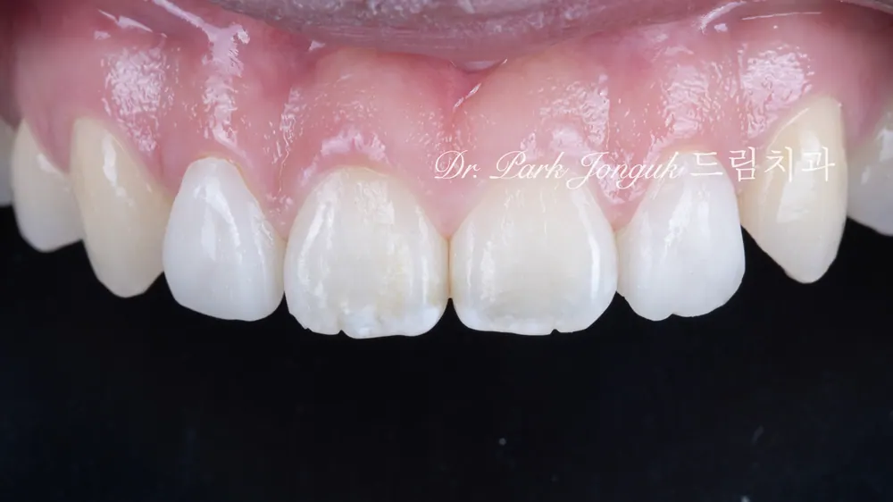 No-prep veneers for peg laterals after braces on both front teeth
