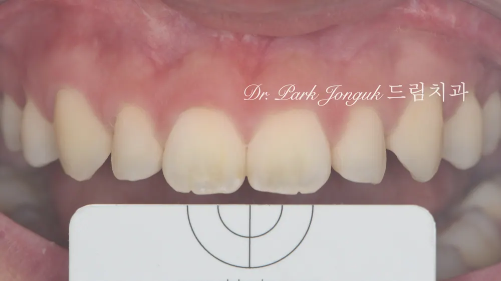 No-prep veneers for peg laterals after braces on both front teeth