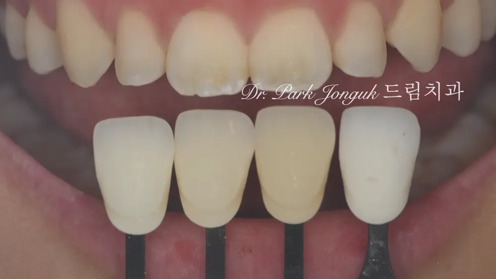 No-Prep Veneers Naturally Correcting a Peg Lateral - A Real Post-Braces Veneer Case — photo 5