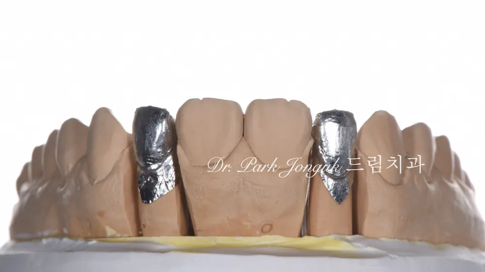 No-prep veneers for peg laterals after braces on both front teeth