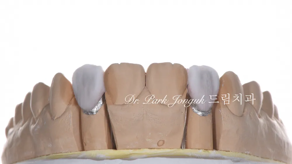 No-prep veneers for peg laterals after braces on both front teeth