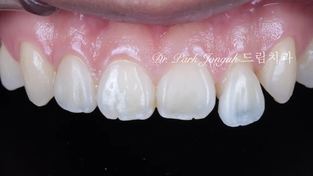 No-prep veneers for peg laterals after braces on both front teeth