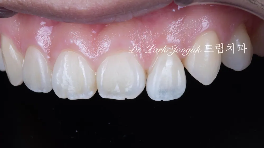 No-prep veneers for peg laterals after braces on both front teeth