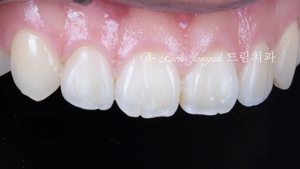 No-prep veneers for peg laterals after braces on both front teeth