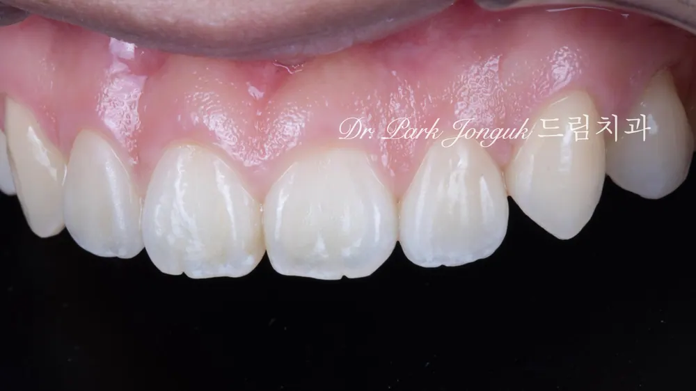 No-prep veneers for peg laterals after braces on both front teeth