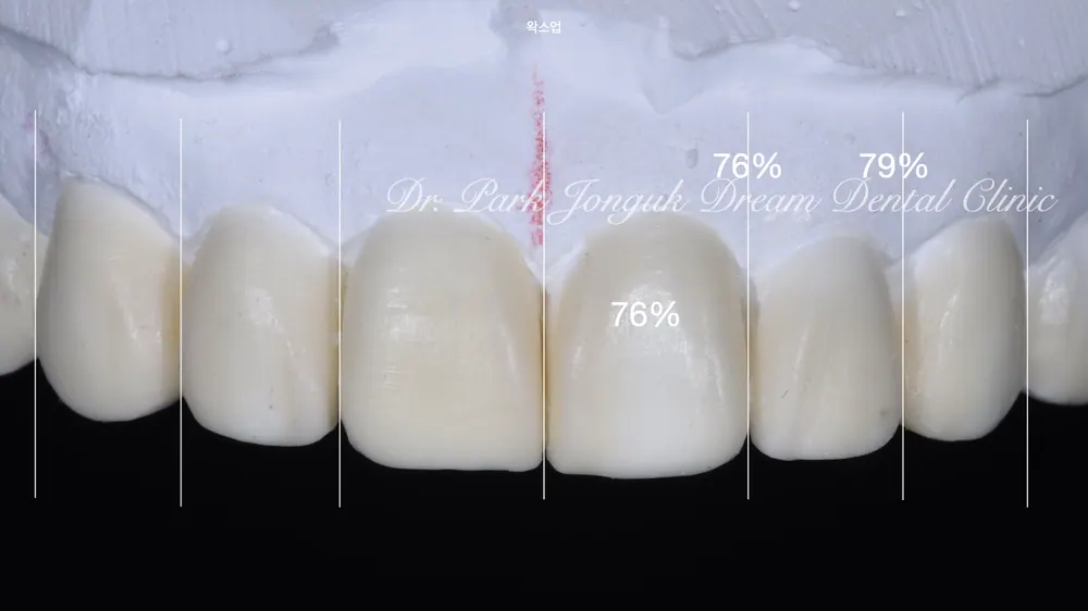 Làm lại Veneer
