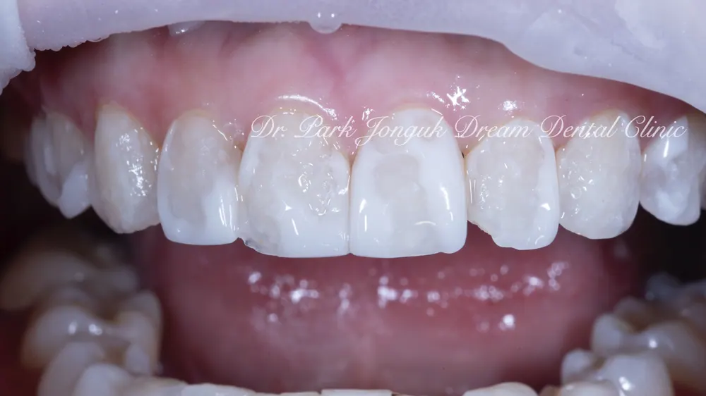 Làm lại Veneer