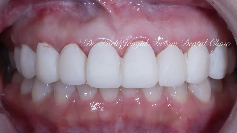 Làm lại Veneer