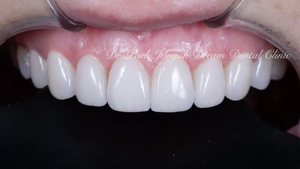Làm lại Veneer