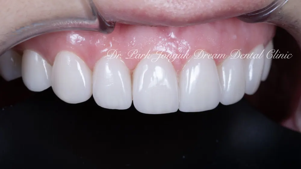 Làm lại Veneer