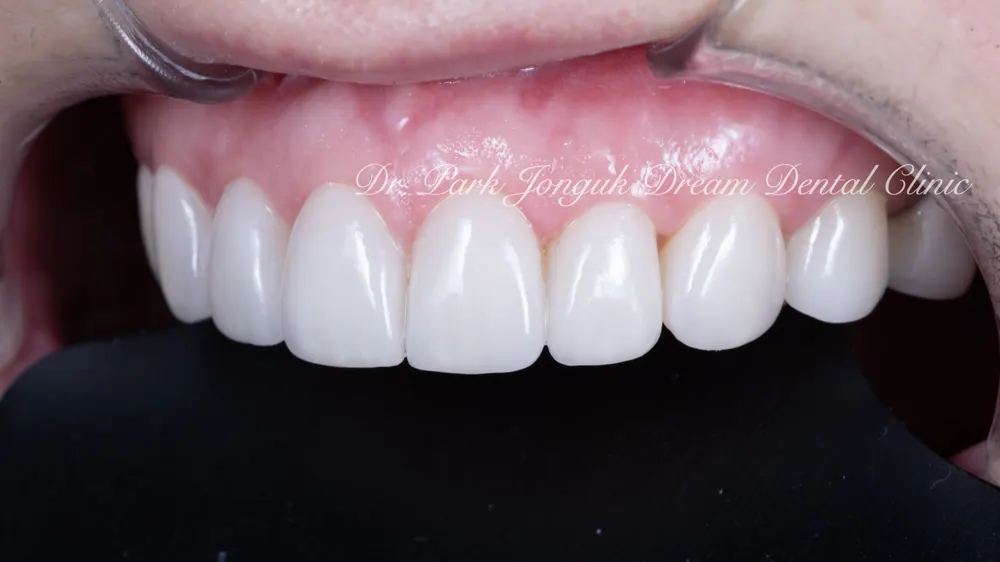 Làm lại Veneer