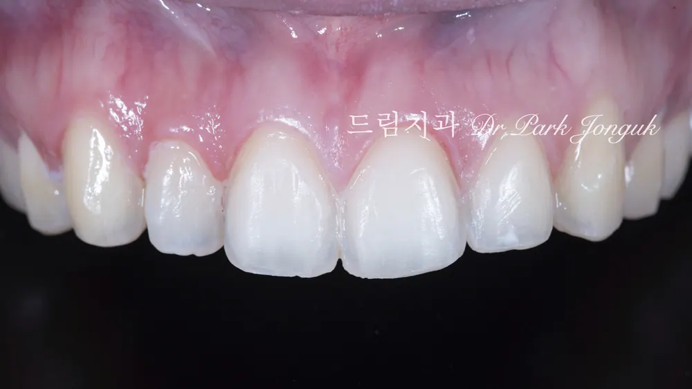 강남 토끼이 라미네이트 잘하는곳