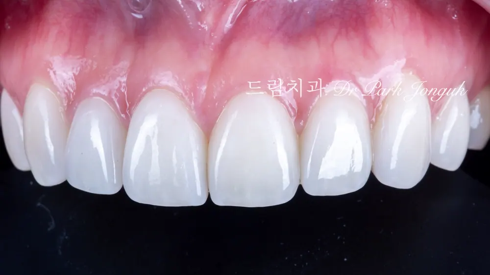 강남 토끼이 라미네이트 잘하는곳