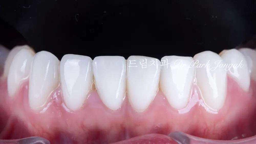 강남 토끼이 라미네이트 잘하는곳