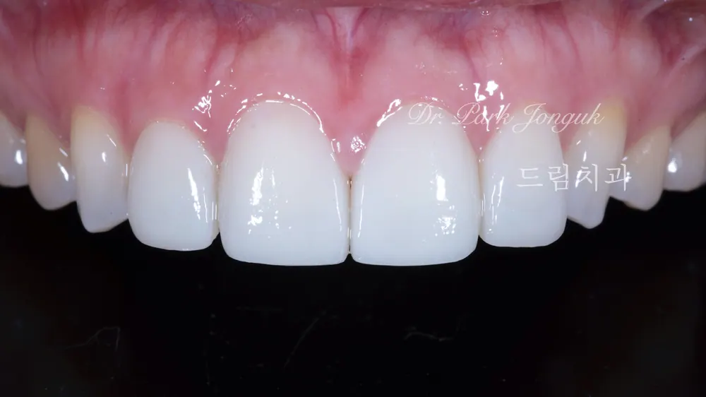 Veneer redo