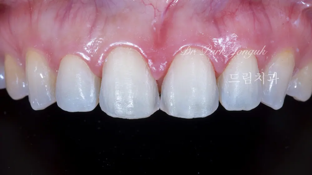 Veneer redo