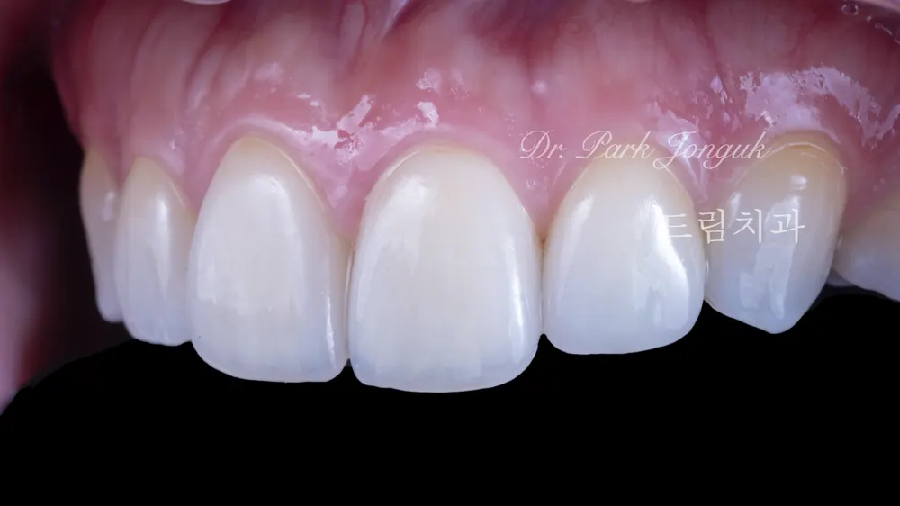Veneer redo