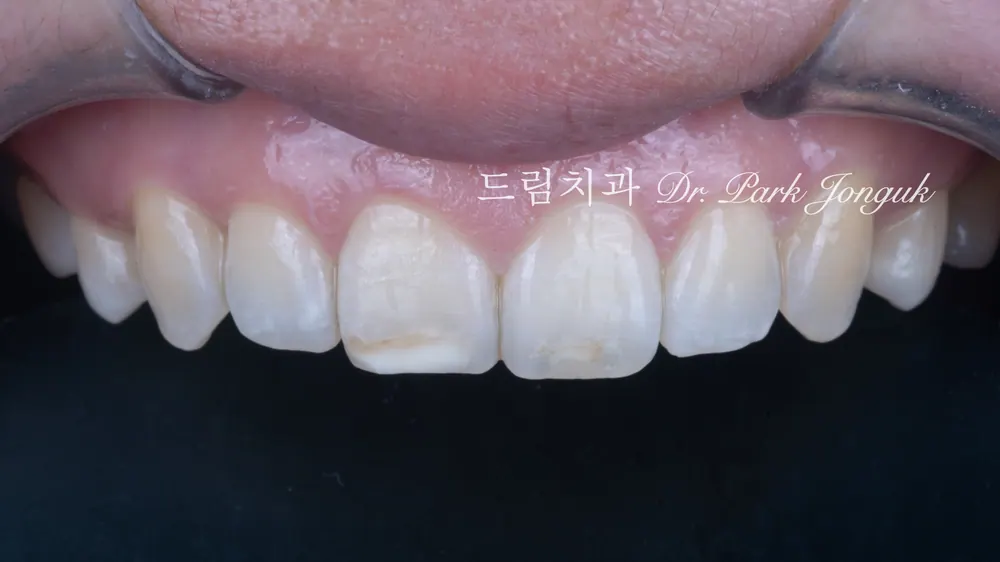 No-prep veneers