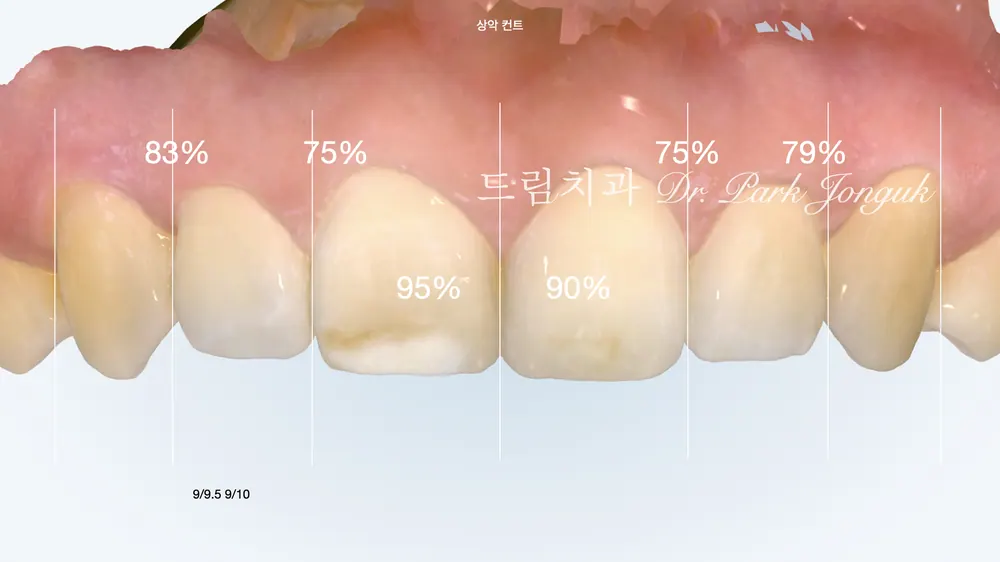 No-prep veneers