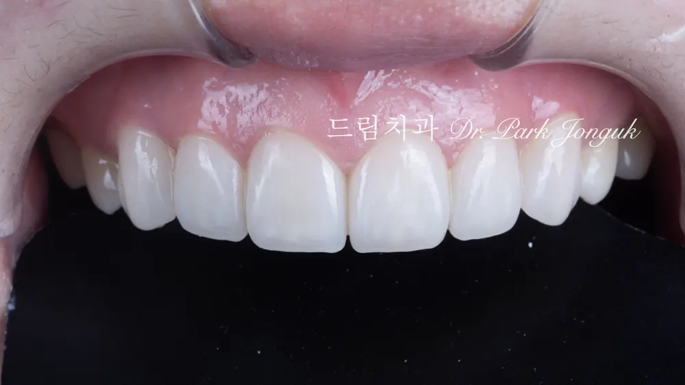 No-prep veneers