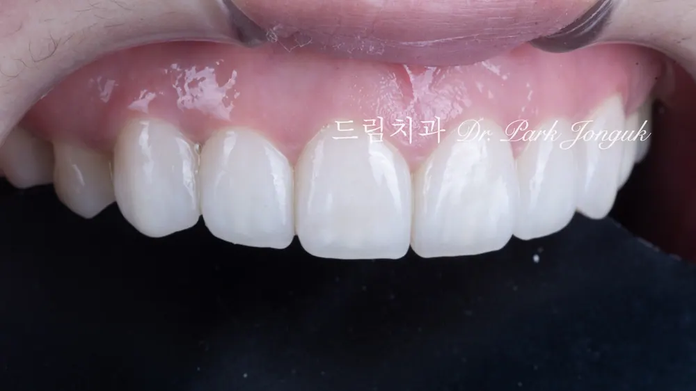 No-prep veneers