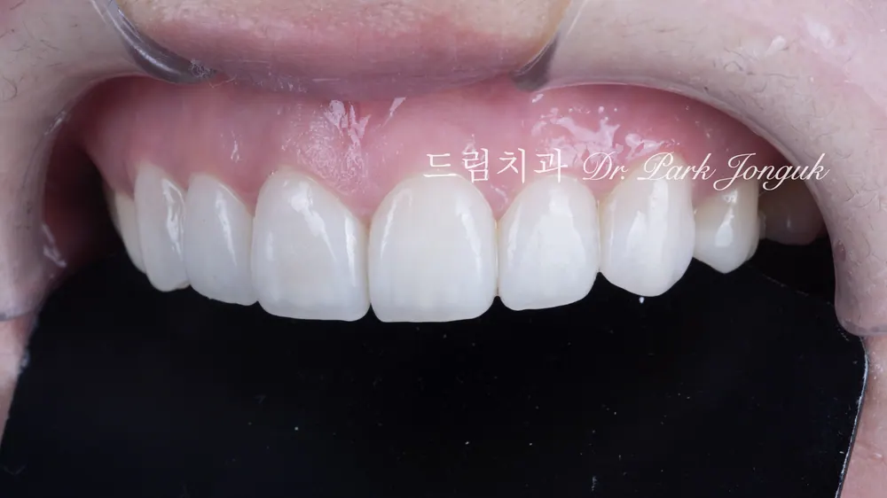 No-prep veneers