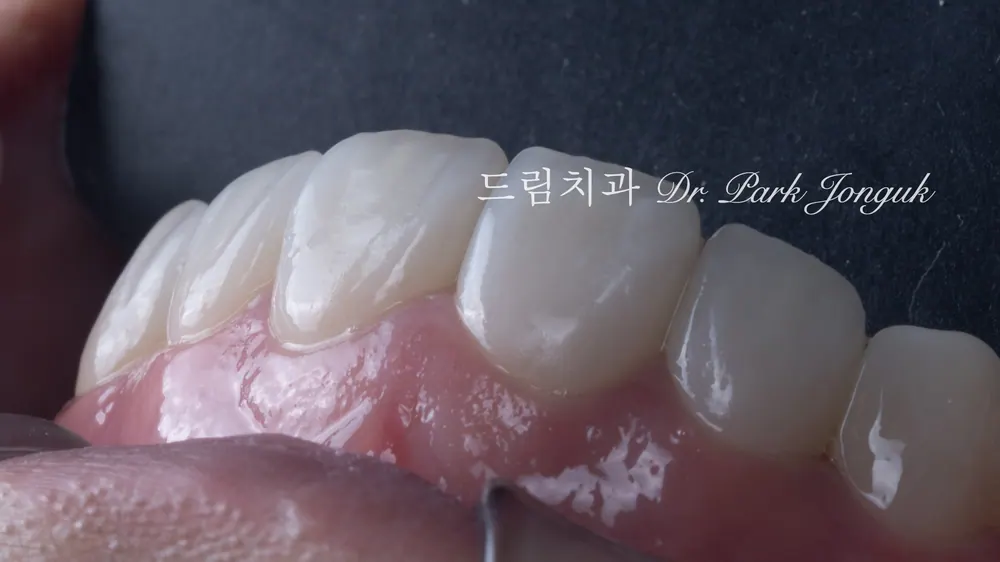 No-prep veneers