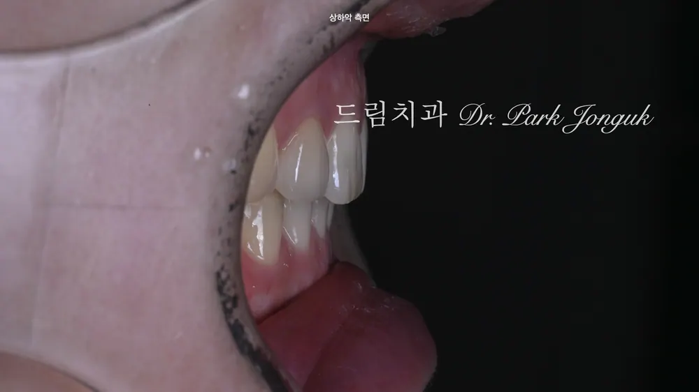 [무삭제 라미네이트] 옥니 교정과 올세라믹 재시술, 서로 다른 보철물의 '색상 매칭'이 핵심입니다 본문 사진 4