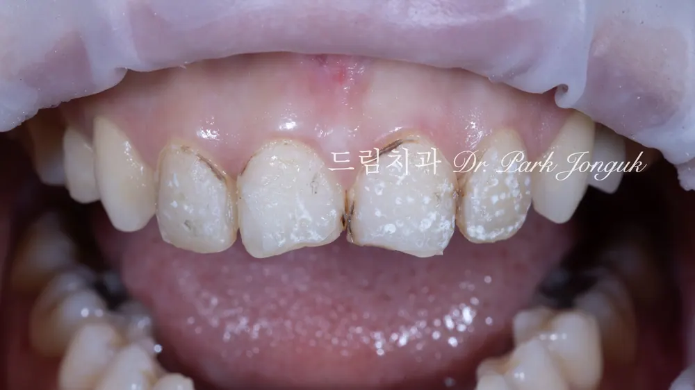 การถอดวีเนียร์ด้วยเลเซอร์เพื่อรักษาซ้ำ