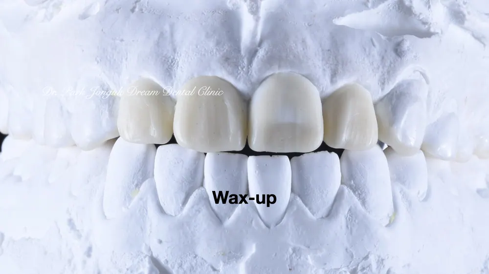 역류성식도염 무삭제 라미네이트 치아 부식 샌드위치 테크닉