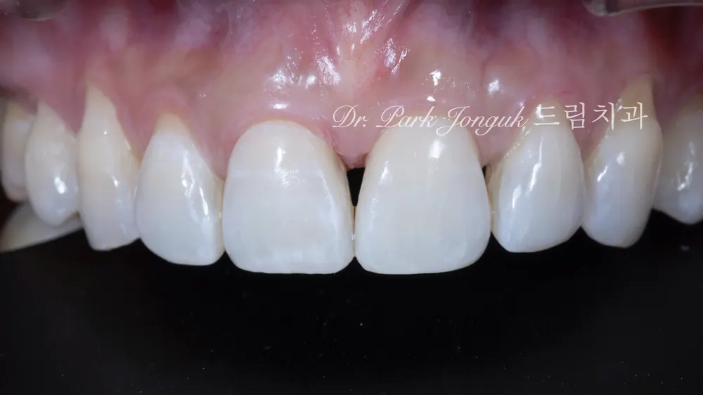 No-prep veneer treatment for black triangles after orthodontics