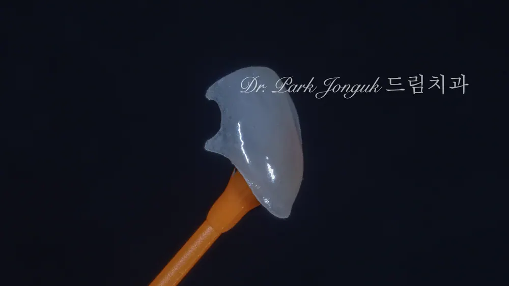 No-prep veneer treatment for black triangles after orthodontics