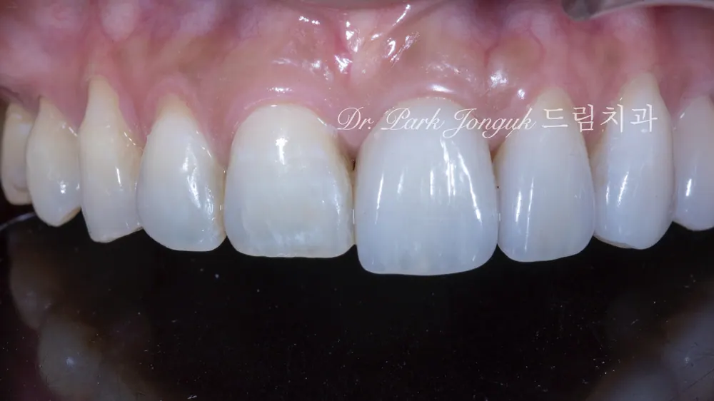 No-prep veneer treatment for black triangles after orthodontics