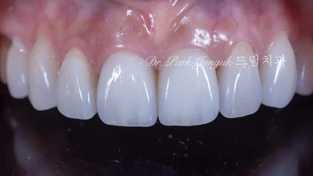 No-prep veneer treatment for black triangles after orthodontics