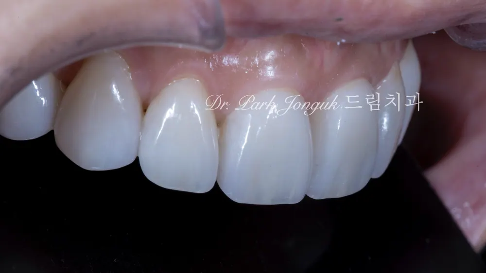No-prep veneer treatment for black triangles after orthodontics