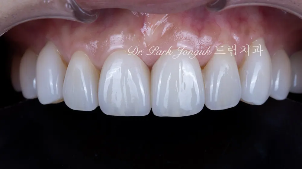 No-prep veneer treatment for black triangles after orthodontics