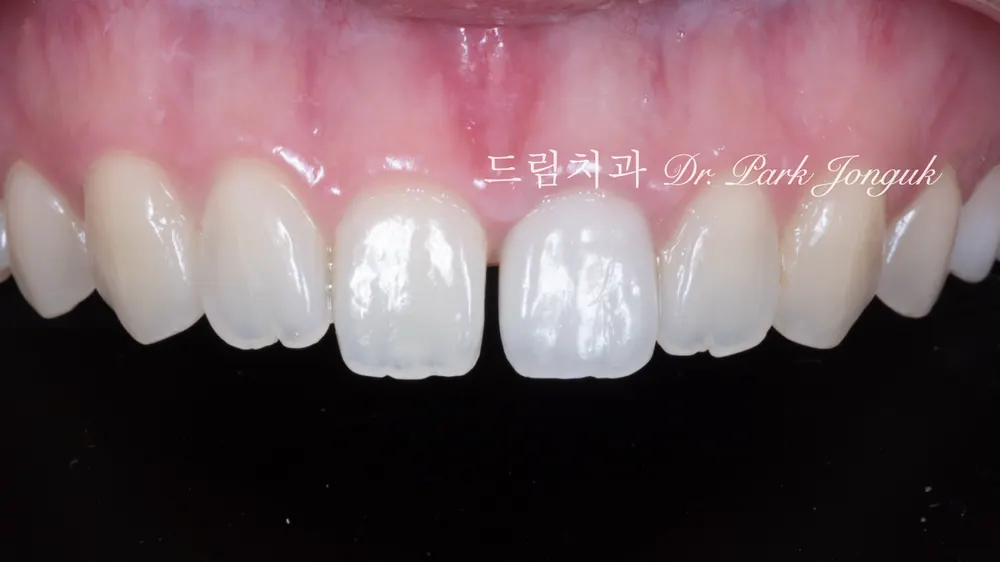 A case combining a no-prep veneer with an all-ceramic crown redo