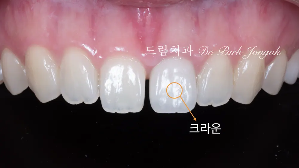 A case combining a no-prep veneer with an all-ceramic crown redo