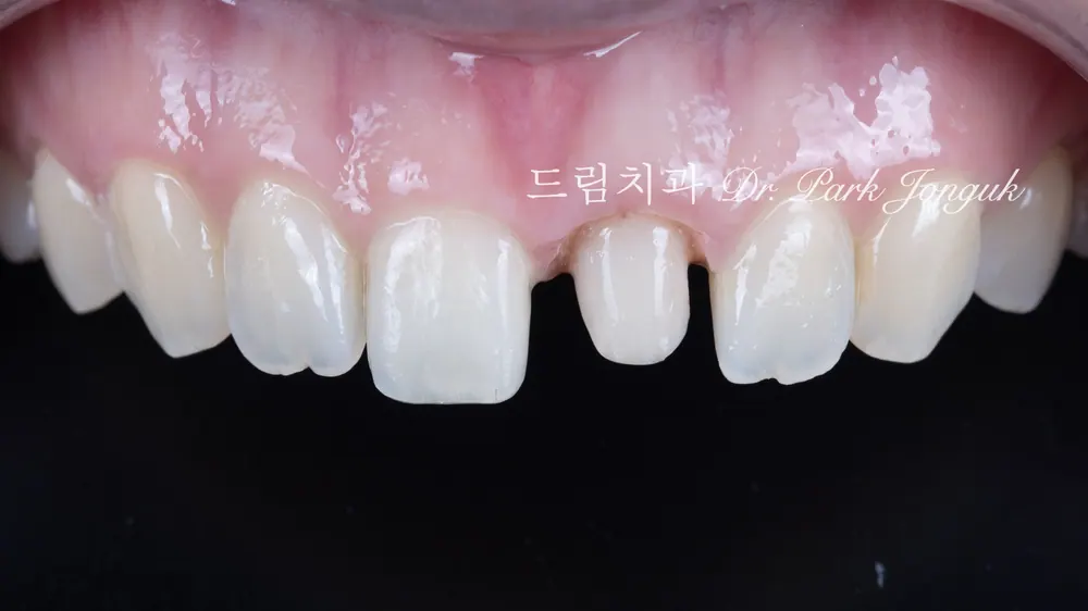 A case combining a no-prep veneer with an all-ceramic crown redo