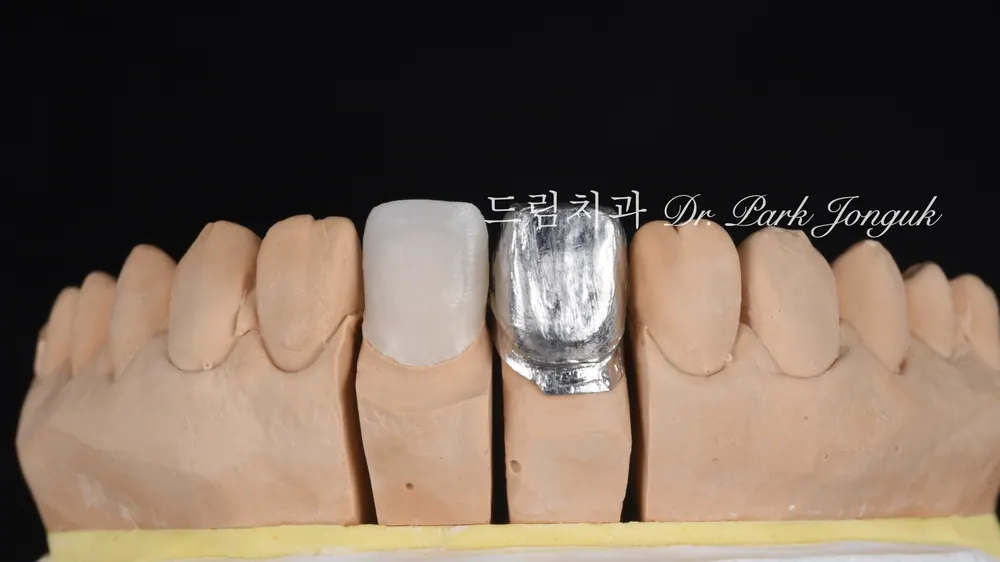 A case combining a no-prep veneer with an all-ceramic crown redo