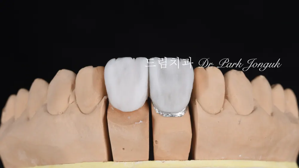 A case combining a no-prep veneer with an all-ceramic crown redo
